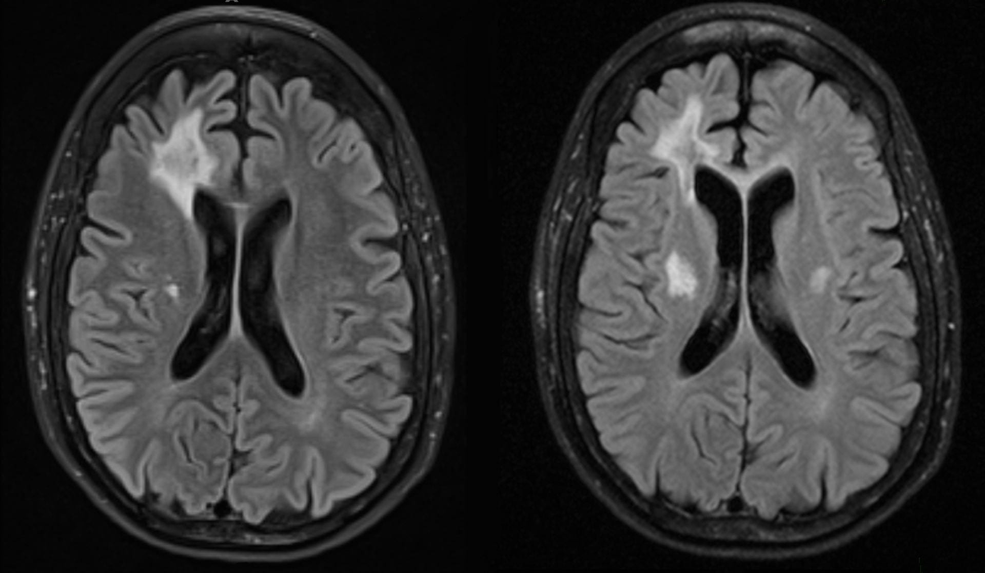 RVCL-S or RVCL brain lesions